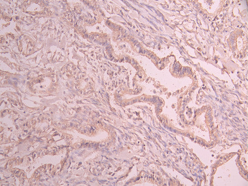 IHC image of CSB-RA044921A0HU diluted at 1:100 and staining in paraffin-embedded human cervical cancer performed on a Leica BondTM system. After dewaxing and hydration, antigen retrieval was mediated by high pressure in a citrate buffer (pH 6.0) . Section was blocked with 10% normal goat serum 30min at RT. Then primary antibody (1% BSA) was incubated at 4°C overnight. The primary is detected by a Goat anti-rabbit polymer IgG labeled by HRP and visualized using 0.05% DAB.