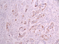 IHC image of CSB-RA047238A0HU diluted at 1:100 and staining in paraffin-embedded human cervical cancer performed on a Leica BondTM system. After dewaxing and hydration, antigen retrieval was mediated by high pressure in a citrate buffer (pH 6.0) . Section was blocked with 10% normal goat serum 30min at RT. Then primary antibody (1% BSA) was incubated at 4°C overnight. The primary is detected by a Goat anti-rabbit polymer IgG labeled by HRP and visualized using 0.05% DAB.