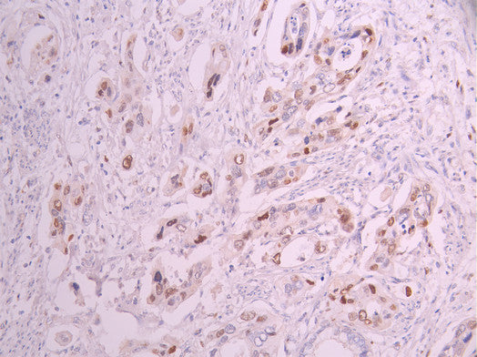 IHC image of CSB-RA047238A0HU diluted at 1:100 and staining in paraffin-embedded human cervical cancer performed on a Leica BondTM system. After dewaxing and hydration, antigen retrieval was mediated by high pressure in a citrate buffer (pH 6.0) . Section was blocked with 10% normal goat serum 30min at RT. Then primary antibody (1% BSA) was incubated at 4°C overnight. The primary is detected by a Goat anti-rabbit polymer IgG labeled by HRP and visualized using 0.05% DAB.