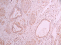 IHC image of CSB-RA047353A0HU diluted at 1:100 and staining in paraffin-embedded human cervical cancer performed on a Leica BondTM system. After dewaxing and hydration, antigen retrieval was mediated by high pressure in a citrate buffer (pH 6.0) . Section was blocked with 10% normal goat serum 30min at RT. Then primary antibody (1% BSA) was incubated at 4°C overnight. The primary is detected by a Goat anti-rabbit polymer IgG labeled by HRP and visualized using 0.05% DAB.