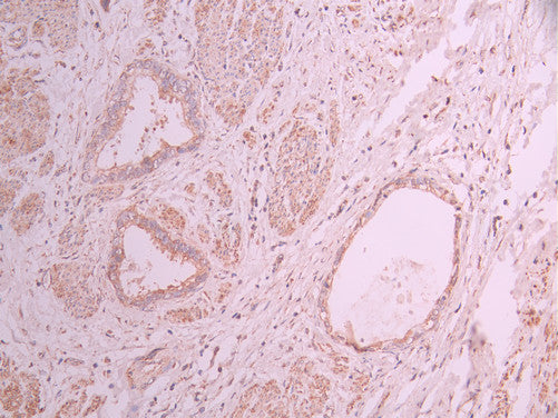 IHC image of CSB-RA047353A0HU diluted at 1:100 and staining in paraffin-embedded human cervical cancer performed on a Leica BondTM system. After dewaxing and hydration, antigen retrieval was mediated by high pressure in a citrate buffer (pH 6.0) . Section was blocked with 10% normal goat serum 30min at RT. Then primary antibody (1% BSA) was incubated at 4°C overnight. The primary is detected by a Goat anti-rabbit polymer IgG labeled by HRP and visualized using 0.05% DAB.