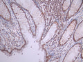 IHC image of CSB-RA049800A0HU diluted at 1:100 and staining in paraffin-embedded human colorectal cancer performed on a Leica BondTM system. After dewaxing and hydration, antigen retrieval was mediated by high pressure in a citrate buffer (pH 6.0). Section was blocked with 10% normal goat serum 30min at RT. Then primary antibody (1% BSA) was incubated at 4°C overnight. The primary is detected by a Goat anti-rabbit polymer IgG labeled by HRP and visualized using 0.05% DAB.