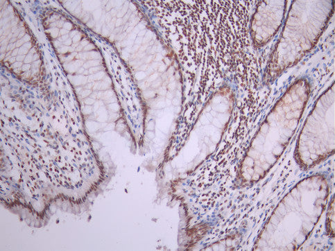 IHC image of CSB-RA049800A0HU diluted at 1:100 and staining in paraffin-embedded human colorectal cancer performed on a Leica BondTM system. After dewaxing and hydration, antigen retrieval was mediated by high pressure in a citrate buffer (pH 6.0). Section was blocked with 10% normal goat serum 30min at RT. Then primary antibody (1% BSA) was incubated at 4°C overnight. The primary is detected by a Goat anti-rabbit polymer IgG labeled by HRP and visualized using 0.05% DAB.