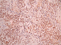 IHC image of CSB-RA089295A0HU diluted at 1:100 and staining in paraffin-embedded human breast cancer performed on a Leica BondTM system. After dewaxing and hydration, antigen retrieval was mediated by high pressure in a citrate buffer (pH 6.0). Section was blocked with 10% normal goat serum 30min at RT. Then primary antibody (1% BSA) was incubated at 4°C overnight. The primary is detected by a Goat anti-rabbit polymer IgG labeled by HRP and visualized using 0.05% DAB.