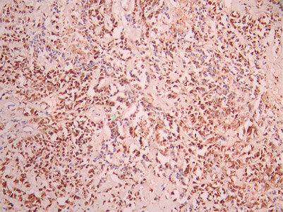IHC image of CSB-RA089295A0HU diluted at 1:100 and staining in paraffin-embedded human breast cancer performed on a Leica BondTM system. After dewaxing and hydration, antigen retrieval was mediated by high pressure in a citrate buffer (pH 6.0). Section was blocked with 10% normal goat serum 30min at RT. Then primary antibody (1% BSA) was incubated at 4°C overnight. The primary is detected by a Goat anti-rabbit polymer IgG labeled by HRP and visualized using 0.05% DAB.