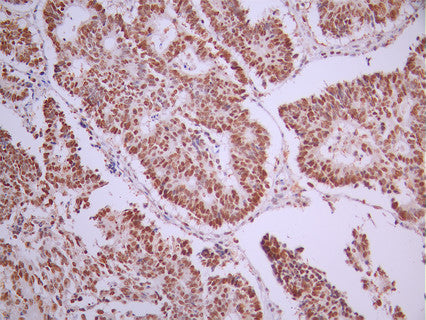 IHC image of CSB-RA091472A0HU diluted at 1:100 and staining in paraffin-embedded human colorectal cancer performed on a Leica BondTM system. After dewaxing and hydration, antigen retrieval was mediated by high pressure in a citrate buffer (pH 6.0). Section was blocked with 10% normal goat serum 30min at RT. Then primary antibody (1% BSA) was incubated at 4°C overnight. The primary is detected by a Goat anti-rabbit polymer IgG labeled by HRP and visualized using 0.05% DAB.