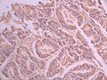 IHC image of CSB-RA093733A0HU diluted at 1:100 and staining in paraffin-embedded human colorectal cancer performed on a Leica BondTM system. After dewaxing and hydration, antigen retrieval was mediated by high pressure in a citrate buffer (pH 6.0) . Section was blocked with 10% normal goat serum 30min at RT. Then primary antibody (1% BSA) was incubated at 4°C overnight. The primary is detected by a Goat anti-rabbit polymer IgG labeled by HRP and visualized using 0.05% DAB.