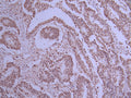 IHC image of CSB-RA098504A0HU diluted at 1:100 and staining in paraffin-embedded human colorectal cancer performed on a Leica BondTM system. After dewaxing and hydration, antigen retrieval was mediated by high pressure in a citrate buffer (pH 6.0) . Section was blocked with 10% normal goat serum 30min at RT. Then primary antibody (1% BSA) was incubated at 4°C overnight. The primary is detected by a Goat anti-rabbit polymer IgG labeled by HRP and visualized using 0.05% DAB.