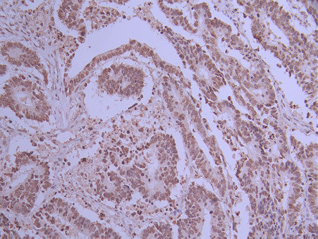 IHC image of CSB-RA098504A0HU diluted at 1:100 and staining in paraffin-embedded human colorectal cancer performed on a Leica BondTM system. After dewaxing and hydration, antigen retrieval was mediated by high pressure in a citrate buffer (pH 6.0) . Section was blocked with 10% normal goat serum 30min at RT. Then primary antibody (1% BSA) was incubated at 4°C overnight. The primary is detected by a Goat anti-rabbit polymer IgG labeled by HRP and visualized using 0.05% DAB.