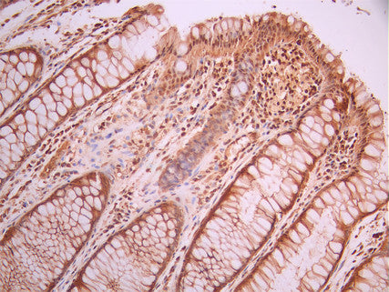 IHC image of CSB-RA101412A0HU diluted at 1:100 and staining in paraffin-embedded human colorectal cancer performed on a Leica BondTM system. After dewaxing and hydration, antigen retrieval was mediated by high pressure in a citrate buffer (pH 6.0). Section was blocked with 10% normal goat serum 30min at RT. Then primary antibody (1% BSA) was incubated at 4°C overnight. The primary is detected by a Goat anti-rabbit polymer IgG labeled by HRP and visualized using 0.05% DAB.