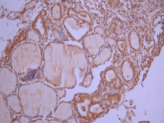 IHC image of CSB-RA102164A0HU diluted at 1:100 and staining in paraffin-embedded human thyroid tissue performed on a Leica BondTM system. After dewaxing and hydration, antigen retrieval was mediated by high pressure in a citrate buffer (pH 6.0). Section was blocked with 10% normal goat serum 30min at RT. Then primary antibody (1% BSA) was incubated at 4°C overnight. The primary is detected by a Goat anti-rabbit polymer IgG labeled by HRP and visualized using 0.05% DAB.