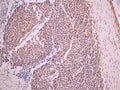 IHC image of CSB-RA103529A0HU diluted at 1:100 and staining in paraffin-embedded human lung cancer performed on a Leica BondTM system. After dewaxing and hydration, antigen retrieval was mediated by high pressure in a citrate buffer (pH 6.0). Section was blocked with 10% normal goat serum 30min at RT. Then primary antibody (1% BSA) was incubated at 4°C overnight. The primary is detected by a Goat anti-rabbit polymer IgG labeled by HRP and visualized using 0.05% DAB.