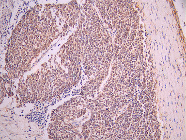 IHC image of CSB-RA103529A0HU diluted at 1:100 and staining in paraffin-embedded human lung cancer performed on a Leica BondTM system. After dewaxing and hydration, antigen retrieval was mediated by high pressure in a citrate buffer (pH 6.0). Section was blocked with 10% normal goat serum 30min at RT. Then primary antibody (1% BSA) was incubated at 4°C overnight. The primary is detected by a Goat anti-rabbit polymer IgG labeled by HRP and visualized using 0.05% DAB.