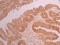 IHC image of CSB-RA105098A0HU diluted at 1:100 and staining in paraffin-embedded human colorectal cancer performed on a Leica BondTM system. After dewaxing and hydration, antigen retrieval was mediated by high pressure in a citrate buffer (pH 6.0) . Section was blocked with 10% normal goat serum 30min at RT. Then primary antibody (1% BSA) was incubated at 4°C overnight. The primary is detected by a Goat anti-rabbit polymer IgG labeled by HRP and visualized using 0.05% DAB.