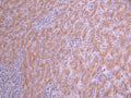 IHC image of CSB-RA108916A0HU diluted at 1:100 and staining in paraffin-embedded human liver cancer performed on a Leica BondTM system. After dewaxing and hydration, antigen retrieval was mediated by high pressure in a citrate buffer (pH 6.0) . Section was blocked with 10% normal goat serum 30min at RT. Then primary antibody (1% BSA) was incubated at 4°C overnight. The primary is detected by a Goat anti-rabbit polymer IgG labeled by HRP and visualized using 0.05% DAB.