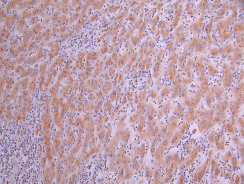 IHC image of CSB-RA108916A0HU diluted at 1:100 and staining in paraffin-embedded human liver cancer performed on a Leica BondTM system. After dewaxing and hydration, antigen retrieval was mediated by high pressure in a citrate buffer (pH 6.0) . Section was blocked with 10% normal goat serum 30min at RT. Then primary antibody (1% BSA) was incubated at 4°C overnight. The primary is detected by a Goat anti-rabbit polymer IgG labeled by HRP and visualized using 0.05% DAB.