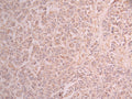 IHC image of CSB-RA116588A0HU diluted at 1:100 and staining in paraffin-embedded human breast cancer performed on a Leica BondTM system. After dewaxing and hydration, antigen retrieval was mediated by high pressure in a citrate buffer (pH 6.0) . Section was blocked with 10% normal goat serum 30min at RT. Then primary antibody (1% BSA) was incubated at 4°C overnight. The primary is detected by a Goat anti-rabbit polymer IgG labeled by HRP and visualized using 0.05% DAB.