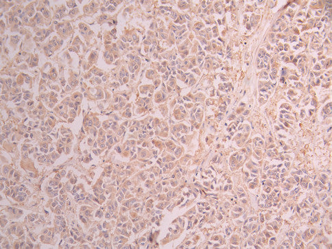 IHC image of CSB-RA116588A0HU diluted at 1:100 and staining in paraffin-embedded human breast cancer performed on a Leica BondTM system. After dewaxing and hydration, antigen retrieval was mediated by high pressure in a citrate buffer (pH 6.0) . Section was blocked with 10% normal goat serum 30min at RT. Then primary antibody (1% BSA) was incubated at 4°C overnight. The primary is detected by a Goat anti-rabbit polymer IgG labeled by HRP and visualized using 0.05% DAB.