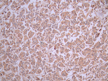 IHC image of CSB-RA118372A0HU diluted at 1:100 and staining in paraffin-embedded human breast cancer performed on a Leica BondTM system. After dewaxing and hydration, antigen retrieval was mediated by high pressure in a citrate buffer (pH 6.0). Section was blocked with 10% normal goat serum 30min at RT. Then primary antibody (1% BSA) was incubated at 4°C overnight. The primary is detected by a Goat anti-rabbit polymer IgG labeled by HRP and visualized using 0.05% DAB.