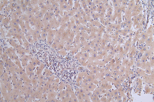 IHC image of CSB-RA119753A0HU diluted at 1:50 and staining in paraffin-embedded human liver cancer performed on a Leica BondTM system. After dewaxing and hydration, antigen retrieval was mediated by high pressure in a citrate buffer (pH 6.0) . Section was blocked with 10% normal goat serum 30min at RT. Then primary antibody (1% BSA) was incubated at 4°C overnight. The primary is detected by a Goat anti-rabbit polymer IgG labeled by HRP and visualized using 0.31% DAB.