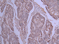 IHC image of CSB-RA122120A0HU diluted at 1:100 and staining in paraffin-embedded human colorectal cancer performed on a Leica BondTM system. After dewaxing and hydration, antigen retrieval was mediated by high pressure in a citrate buffer (pH 6.0) . Section was blocked with 10% normal goat serum 30min at RT. Then primary antibody (1% BSA) was incubated at 4°C overnight. The primary is detected by a Goat anti-rabbit polymer IgG labeled by HRP and visualized using 0.05% DAB.