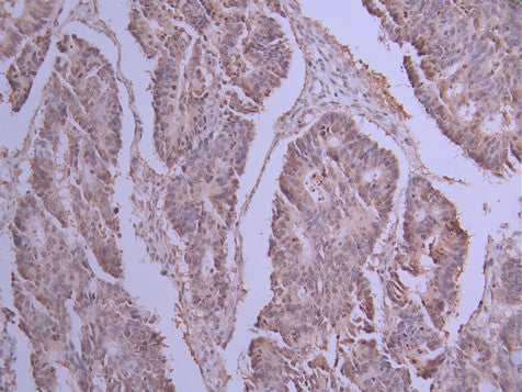 IHC image of CSB-RA122120A0HU diluted at 1:100 and staining in paraffin-embedded human colorectal cancer performed on a Leica BondTM system. After dewaxing and hydration, antigen retrieval was mediated by high pressure in a citrate buffer (pH 6.0) . Section was blocked with 10% normal goat serum 30min at RT. Then primary antibody (1% BSA) was incubated at 4°C overnight. The primary is detected by a Goat anti-rabbit polymer IgG labeled by HRP and visualized using 0.05% DAB.