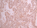 IHC image of CSB-RA145805A0HU diluted at 1:100 and staining in paraffin-embedded human lung cancer performed on a Leica BondTM system. After dewaxing and hydration, antigen retrieval was mediated by high pressure in a citrate buffer (pH 6.0) . Section was blocked with 10% normal goat serum 30min at RT. Then primary antibody (1% BSA) was incubated at 4°C overnight. The primary is detected by a Goat anti-rabbit polymer IgG labeled by HRP and visualized using 0.05% DAB.