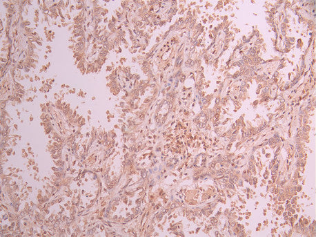 IHC image of CSB-RA145805A0HU diluted at 1:100 and staining in paraffin-embedded human lung cancer performed on a Leica BondTM system. After dewaxing and hydration, antigen retrieval was mediated by high pressure in a citrate buffer (pH 6.0) . Section was blocked with 10% normal goat serum 30min at RT. Then primary antibody (1% BSA) was incubated at 4°C overnight. The primary is detected by a Goat anti-rabbit polymer IgG labeled by HRP and visualized using 0.05% DAB.