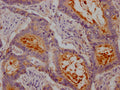 IHC image of CSB-RA147192A0HU diluted at 1:100 and staining in paraffin-embedded human colon cancer performed on a Leica BondTM system. After dewaxing and hydration, antigen retrieval was mediated by high pressure in a citrate buffer (pH 6.0) . Section was blocked with 10% normal goat serum 30min at RT. Then primary antibody (1% BSA) was incubated at 4℃ overnight. The primary is detected by a Goat anti-rabbit IgG polymer labeled by HRP and visualized using 0.05% DAB.