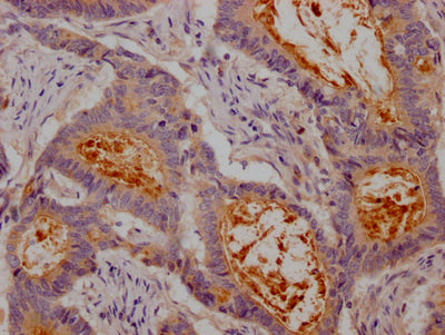 IHC image of CSB-RA147192A0HU diluted at 1:100 and staining in paraffin-embedded human colon cancer performed on a Leica BondTM system. After dewaxing and hydration, antigen retrieval was mediated by high pressure in a citrate buffer (pH 6.0) . Section was blocked with 10% normal goat serum 30min at RT. Then primary antibody (1% BSA) was incubated at 4℃ overnight. The primary is detected by a Goat anti-rabbit IgG polymer labeled by HRP and visualized using 0.05% DAB.