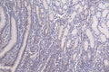 IHC image of CSB-RA148519A0HU diluted at 1:100 and staining in paraffin-embedded human breast cancer performed on a Leica BondTM system. After dewaxing and hydration, antigen retrieval was mediated by high pressure in a citrate buffer (pH 6.0) . Section was blocked with 10% normal goat serum 30min at RT. Then primary antibody (1% BSA) was incubated at 4°C overnight. The primary is detected by a Goat anti-rabbit polymer IgG labeled by HRP and visualized using 0.09% DAB.
