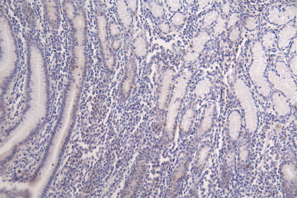 IHC image of CSB-RA148519A0HU diluted at 1:100 and staining in paraffin-embedded human breast cancer performed on a Leica BondTM system. After dewaxing and hydration, antigen retrieval was mediated by high pressure in a citrate buffer (pH 6.0) . Section was blocked with 10% normal goat serum 30min at RT. Then primary antibody (1% BSA) was incubated at 4°C overnight. The primary is detected by a Goat anti-rabbit polymer IgG labeled by HRP and visualized using 0.09% DAB.