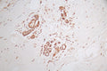 IHC image of CSB-RA150369A0HU diluted at 1:50 and staining in paraffin-embedded human breast cancer performed on a Leica BondTM system. After dewaxing and hydration, antigen retrieval was mediated by high pressure in a citrate buffer (pH 6.0) . Section was blocked with 10% normal goat serum 30min at RT. Then primary antibody (1% BSA) was incubated at 4°C overnight. The primary is detected by a Goat anti-rabbit polymer IgG labeled by HRP and visualized using 0.58% DAB.