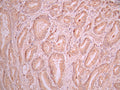 IHC image of CSB-RA151954A0HU diluted at 1:100 and staining in paraffin-embedded human prostate cancer performed on a Leica BondTM system. After dewaxing and hydration, antigen retrieval was mediated by high pressure in a citrate buffer (pH 6.0). Section was blocked with 10% normal goat serum 30min at RT. Then primary antibody (1% BSA) was incubated at 4°C overnight. The primary is detected by a Goat anti-rabbit polymer IgG labeled by HRP and visualized using 0.05% DAB.