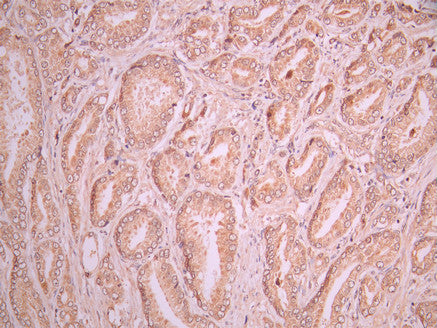 IHC image of CSB-RA151954A0HU diluted at 1:100 and staining in paraffin-embedded human prostate cancer performed on a Leica BondTM system. After dewaxing and hydration, antigen retrieval was mediated by high pressure in a citrate buffer (pH 6.0). Section was blocked with 10% normal goat serum 30min at RT. Then primary antibody (1% BSA) was incubated at 4°C overnight. The primary is detected by a Goat anti-rabbit polymer IgG labeled by HRP and visualized using 0.05% DAB.