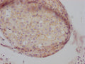 IHC image of CSB-RA155605A0HU diluted at 1:100 and staining in paraffin-embedded human breast cancer performed on a Leica BondTM system. After dewaxing and hydration, antigen retrieval was mediated by high pressure in a citrate buffer (pH 6.0) . Section was blocked with 10% normal goat serum 30min at RT. Then primary antibody (1% BSA) was incubated at 4℃ overnight. The primary is detected by a Goat anti-rabbit IgG polymer labeled by HRP and visualized using 0.05% DAB.
