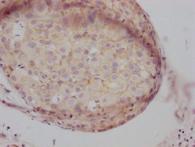 IHC image of CSB-RA155605A0HU diluted at 1:100 and staining in paraffin-embedded human breast cancer performed on a Leica BondTM system. After dewaxing and hydration, antigen retrieval was mediated by high pressure in a citrate buffer (pH 6.0) . Section was blocked with 10% normal goat serum 30min at RT. Then primary antibody (1% BSA) was incubated at 4℃ overnight. The primary is detected by a Goat anti-rabbit IgG polymer labeled by HRP and visualized using 0.05% DAB.
