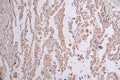 IHC image of CSB-RA156336A0HU diluted at 1:50 and staining in paraffin-embedded human lung cancer performed on a Leica BondTM system. After dewaxing and hydration, antigen retrieval was mediated by high pressure in a citrate buffer (pH 6.0) . Section was blocked with 10% normal goat serum 30min at RT. Then primary antibody (1% BSA) was incubated at 4°C overnight. The primary is detected by a Goat anti-rabbit polymer IgG labeled by HRP and visualized using 0.26% DAB.