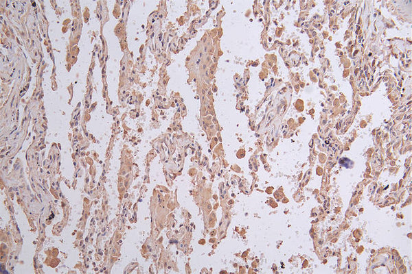 IHC image of CSB-RA156336A0HU diluted at 1:50 and staining in paraffin-embedded human lung cancer performed on a Leica BondTM system. After dewaxing and hydration, antigen retrieval was mediated by high pressure in a citrate buffer (pH 6.0) . Section was blocked with 10% normal goat serum 30min at RT. Then primary antibody (1% BSA) was incubated at 4°C overnight. The primary is detected by a Goat anti-rabbit polymer IgG labeled by HRP and visualized using 0.26% DAB.