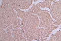 IHC image of CSB-RA159341MA1HU diluted at 1:50 and staining in paraffin-embedded human lung cancer performed on a Leica BondTM system. After dewaxing and hydration, antigen retrieval was mediated by high pressure in a citrate buffer (pH 6.0) . Section was blocked with 10% normal goat serum 30min at RT. Then primary antibody (1% BSA) was incubated at 4°C overnight. The primary is detected by a Goat anti-rabbit polymer IgG labeled by HRP and visualized using 0.05% DAB.