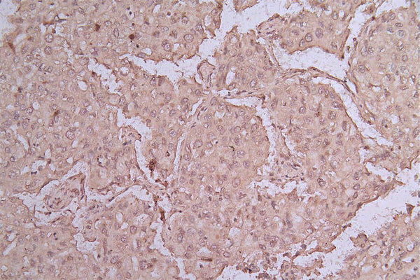 IHC image of CSB-RA159341MA1HU diluted at 1:50 and staining in paraffin-embedded human lung cancer performed on a Leica BondTM system. After dewaxing and hydration, antigen retrieval was mediated by high pressure in a citrate buffer (pH 6.0) . Section was blocked with 10% normal goat serum 30min at RT. Then primary antibody (1% BSA) was incubated at 4°C overnight. The primary is detected by a Goat anti-rabbit polymer IgG labeled by HRP and visualized using 0.05% DAB.