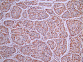 IHC image of CSB-RA160607A0HU diluted at 1:100 and staining in paraffin-embedded human liver cancer performed on a Leica BondTM system. After dewaxing and hydration, antigen retrieval was mediated by high pressure in a citrate buffer (pH 6.0). Section was blocked with 10% normal goat serum 30min at RT. Then primary antibody (1% BSA) was incubated at 4°C overnight. The primary is detected by a Goat anti-rabbit polymer IgG labeled by HRP and visualized using 0.05% DAB.