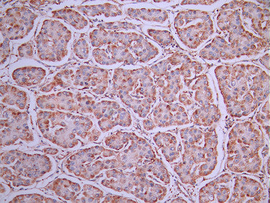 IHC image of CSB-RA160607A0HU diluted at 1:100 and staining in paraffin-embedded human liver cancer performed on a Leica BondTM system. After dewaxing and hydration, antigen retrieval was mediated by high pressure in a citrate buffer (pH 6.0). Section was blocked with 10% normal goat serum 30min at RT. Then primary antibody (1% BSA) was incubated at 4°C overnight. The primary is detected by a Goat anti-rabbit polymer IgG labeled by HRP and visualized using 0.05% DAB.