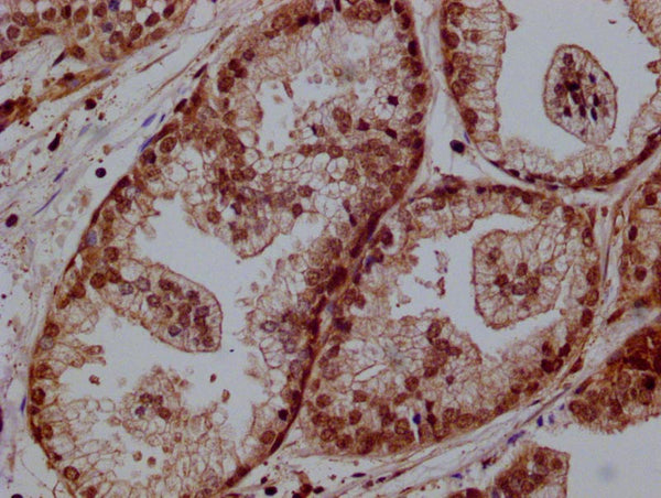 IHC image of CSB-RA161743A0HU diluted at 1:100 and staining in paraffin-embedded human Prostate cancer performed on a Leica BondTM system. After dewaxing and hydration, antigen retrieval was mediated by high pressure in a citrate buffer (pH 6.0) . Section was blocked with 10% normal goat serum 30min at RT. Then primary antibody (1% BSA) was incubated at 4°C overnight. The primary is detected by a Goat anti-rabbit polymer IgG labeled by HRP and visualized using 0.05% DAB.