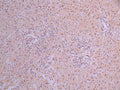 IHC image of CSB-RA162790A0HU diluted at 1:100 and staining in paraffin-embedded human liver cancer performed on a Leica BondTM system. After dewaxing and hydration, antigen retrieval was mediated by high pressure in a citrate buffer (pH 6.0) . Section was blocked with 10% normal goat serum 30min at RT. Then primary antibody (1% BSA) was incubated at 4°C overnight. The primary is detected by a Goat anti-rabbit polymer IgG labeled by HRP and visualized using 0.05% DAB.