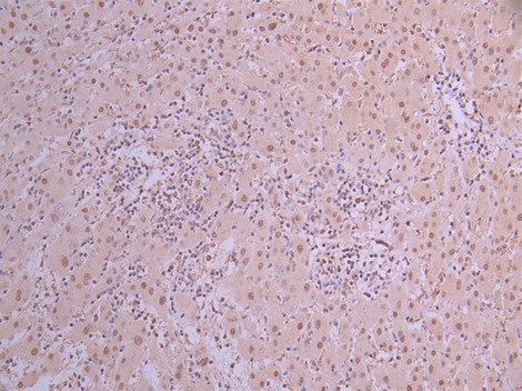 IHC image of CSB-RA162790A0HU diluted at 1:100 and staining in paraffin-embedded human liver cancer performed on a Leica BondTM system. After dewaxing and hydration, antigen retrieval was mediated by high pressure in a citrate buffer (pH 6.0) . Section was blocked with 10% normal goat serum 30min at RT. Then primary antibody (1% BSA) was incubated at 4°C overnight. The primary is detected by a Goat anti-rabbit polymer IgG labeled by HRP and visualized using 0.05% DAB.