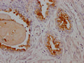 IHC image of CSB-RA162924A0HU diluted at 1:100 and staining in paraffin-embedded human prostate cancer performed on a Leica BondTM system. After dewaxing and hydration, antigen retrieval was mediated by high pressure in a citrate buffer (pH 6.0) . Section was blocked with 10% normal goat serum 30min at RT. Then primary antibody (1% BSA) was incubated at 4℃ overnight. The primary is detected by a Goat anti-rabbit IgG polymer labeled by HRP and visualized using 0.05% DAB.