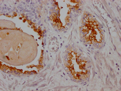IHC image of CSB-RA162924A0HU diluted at 1:100 and staining in paraffin-embedded human prostate cancer performed on a Leica BondTM system. After dewaxing and hydration, antigen retrieval was mediated by high pressure in a citrate buffer (pH 6.0) . Section was blocked with 10% normal goat serum 30min at RT. Then primary antibody (1% BSA) was incubated at 4℃ overnight. The primary is detected by a Goat anti-rabbit IgG polymer labeled by HRP and visualized using 0.05% DAB.