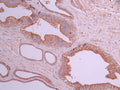 IHC image of CSB-RA163699A0HU diluted at 1:100 and staining in paraffin-embedded human prostate cancer performed on a Leica BondTM system. After dewaxing and hydration, antigen retrieval was mediated by high pressure in a citrate buffer (pH 6.0) . Section was blocked with 10% normal goat serum 30min at RT. Then primary antibody (1% BSA) was incubated at 4°C overnight. The primary is detected by a Goat anti-rabbit polymer IgG labeled by HRP and visualized using 0.05% DAB.