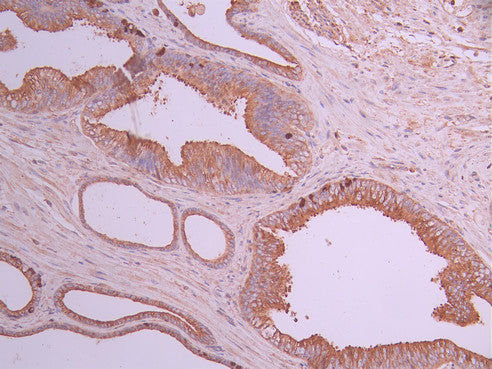 IHC image of CSB-RA163699A0HU diluted at 1:100 and staining in paraffin-embedded human prostate cancer performed on a Leica BondTM system. After dewaxing and hydration, antigen retrieval was mediated by high pressure in a citrate buffer (pH 6.0) . Section was blocked with 10% normal goat serum 30min at RT. Then primary antibody (1% BSA) was incubated at 4°C overnight. The primary is detected by a Goat anti-rabbit polymer IgG labeled by HRP and visualized using 0.05% DAB.